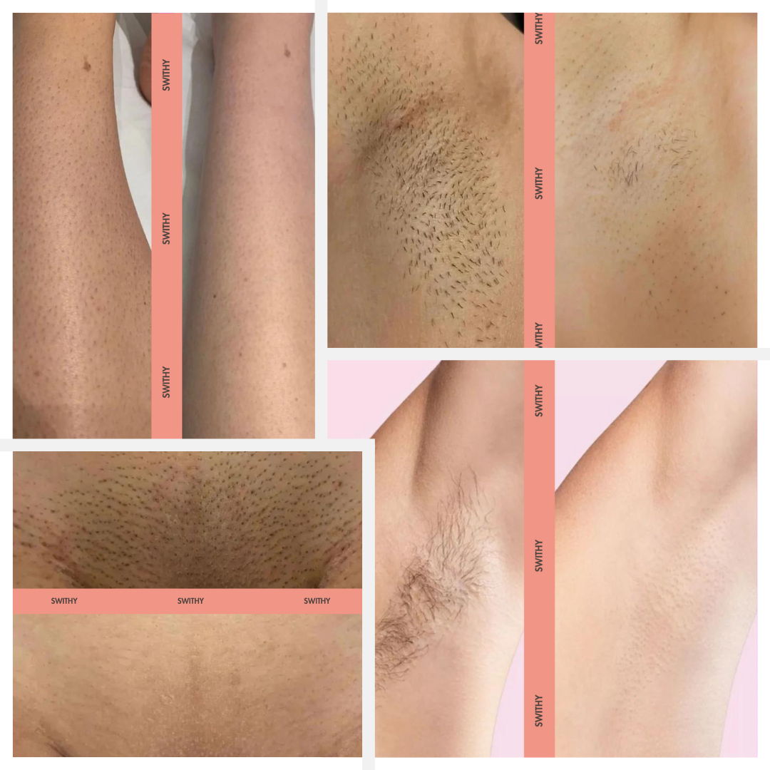 IPL Hair Removal Pro